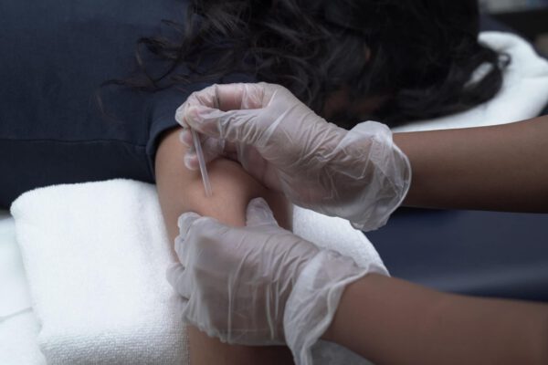 Dry Needling